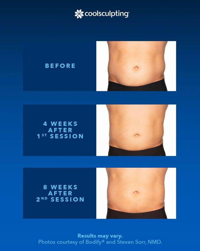 4 Reasons Why CoolSculpting® ELITE is Better than CoolSculpting
