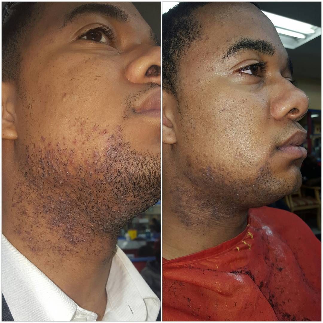 A before and after picture of a man 's beard