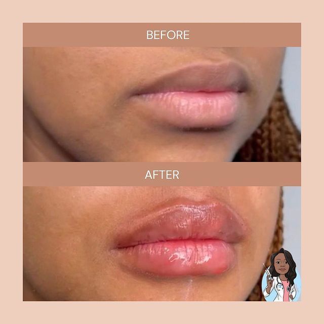 A before and after photo of a woman's lips.