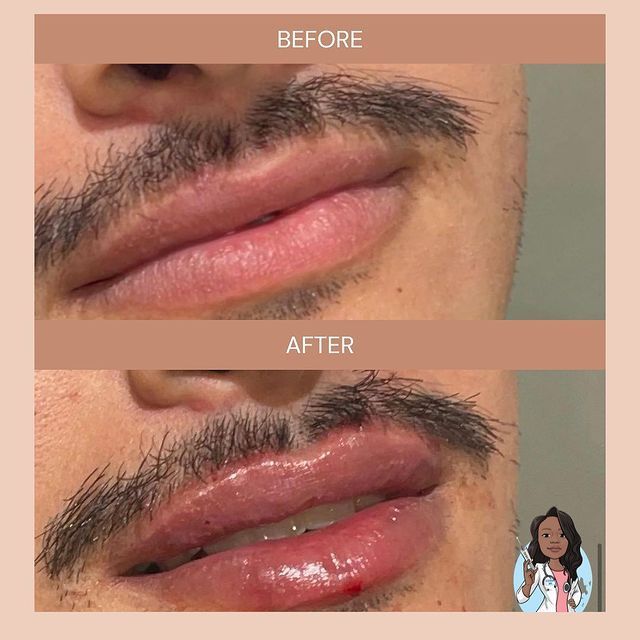 A before and after picture of a man's lips with a beard.