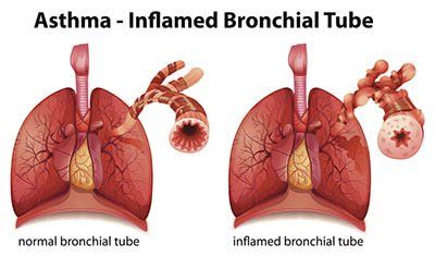 Bronchial Tube Chart - Asthma Treatment in Tampa, FL