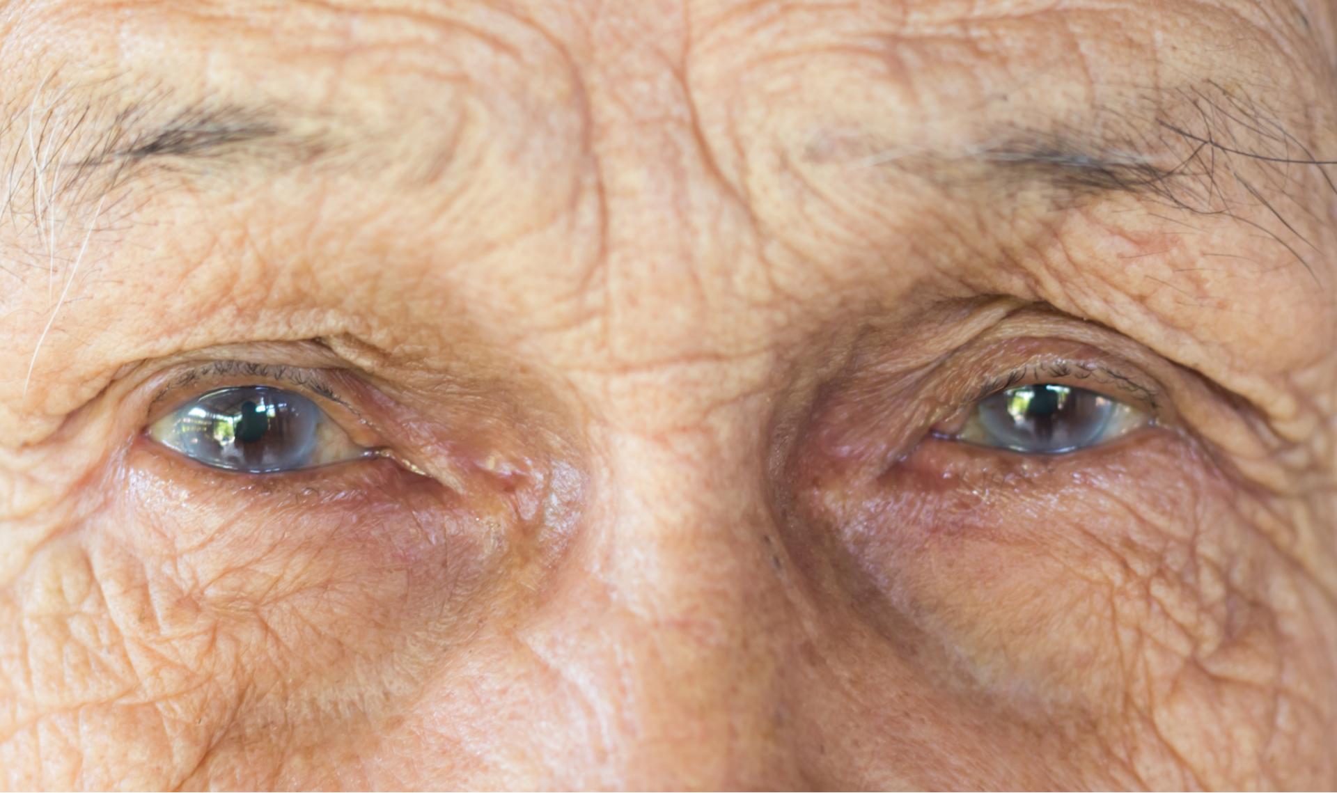 Катаракта слезится глаз. Старческая(сенильная)катаракта. Электроофтальмия, катаракта. Дерматогенная катаракта. Заболевания глаз в пожилом возрасте.