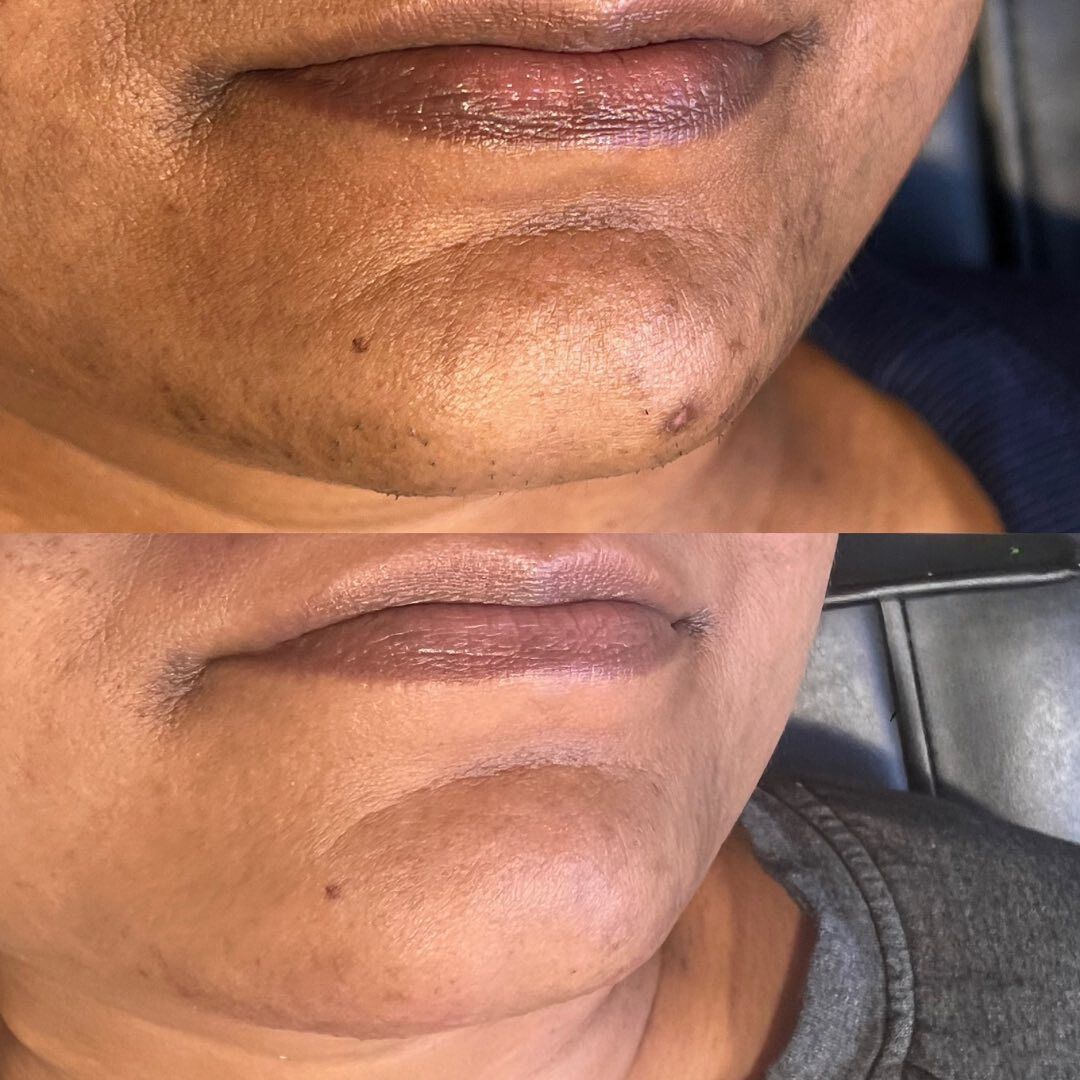Close-up of a lower face with dark spot pigmentation on the chin and jawline, shown before and after treatment.