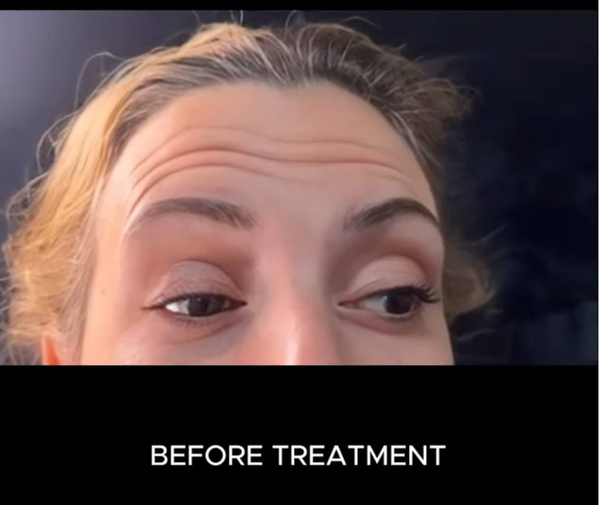 Woman's forehead with prominent wrinkles, labeled 