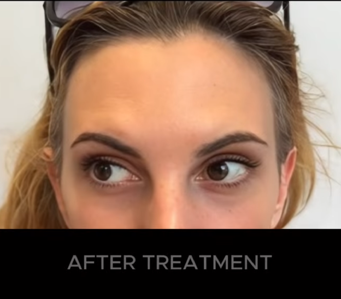 Woman's face after treatment. Close up shot of eyes and forehead, looking slightly to the side.