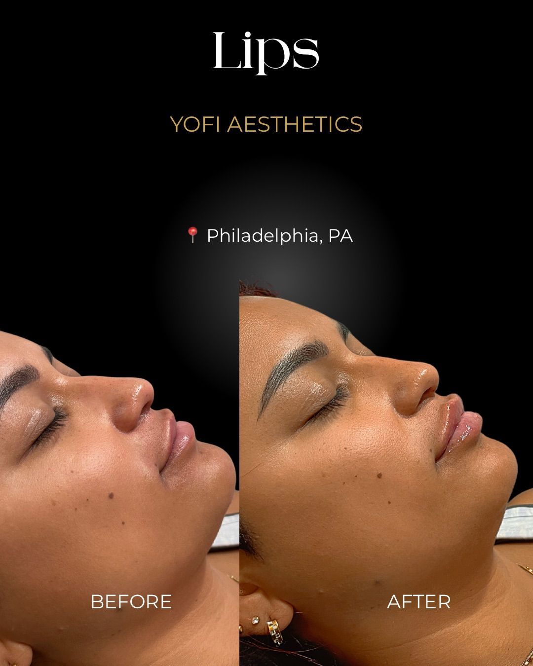 Before/after photo of lips. Yofi Aesthetics, Philadelphia, PA. Left: thinner lips. Right: fuller lips.
