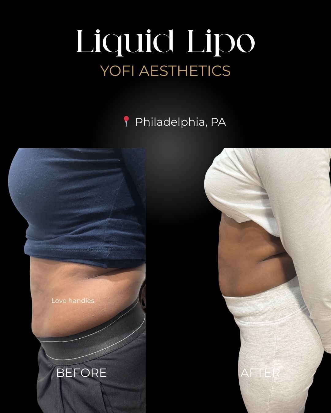 Before and after images of a person's abdomen, labeled 
