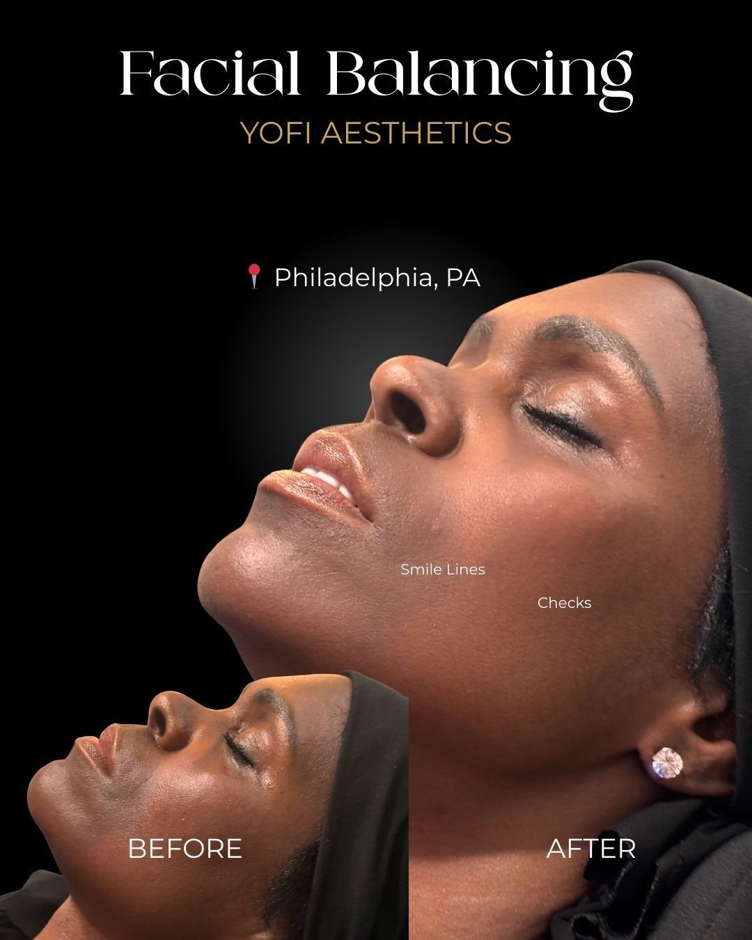 Facial Balancing ad. Before and after photos of a person's face. After shows improved skin tone and contours. Black background. Philadelphia, PA.