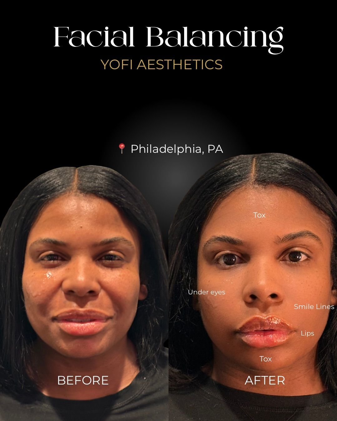 Side-by-side comparison of a person's face before and after facial balancing treatments. Dark hair, black background.