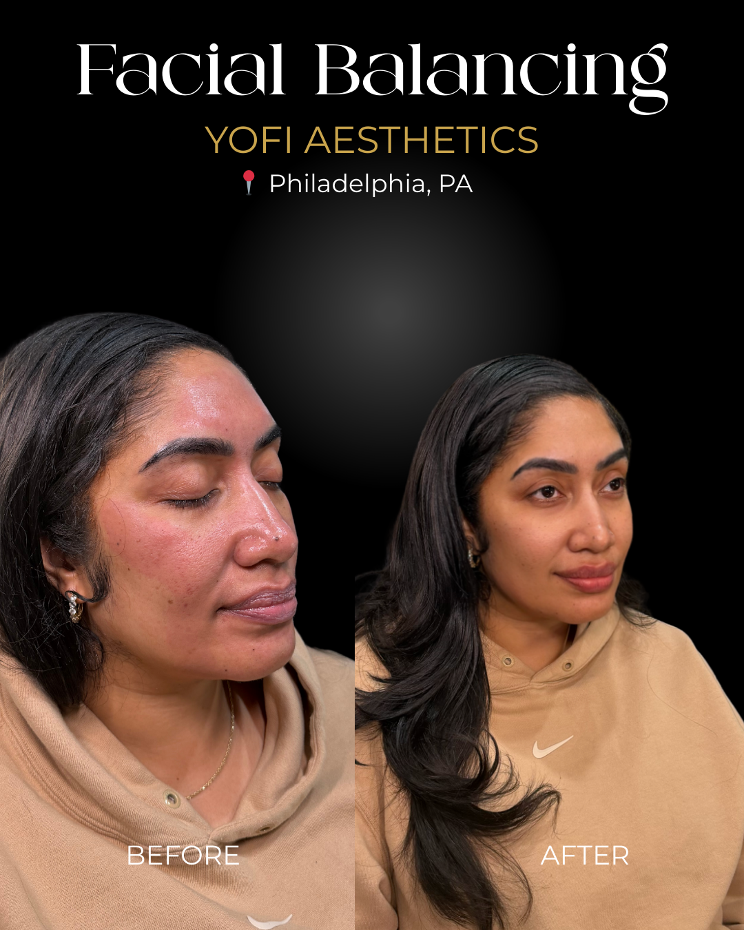 Facial balancing before/after. Woman with closed eyes, then looking forward. Black background, text: Yofi Aesthetics, Philadelphia, PA.