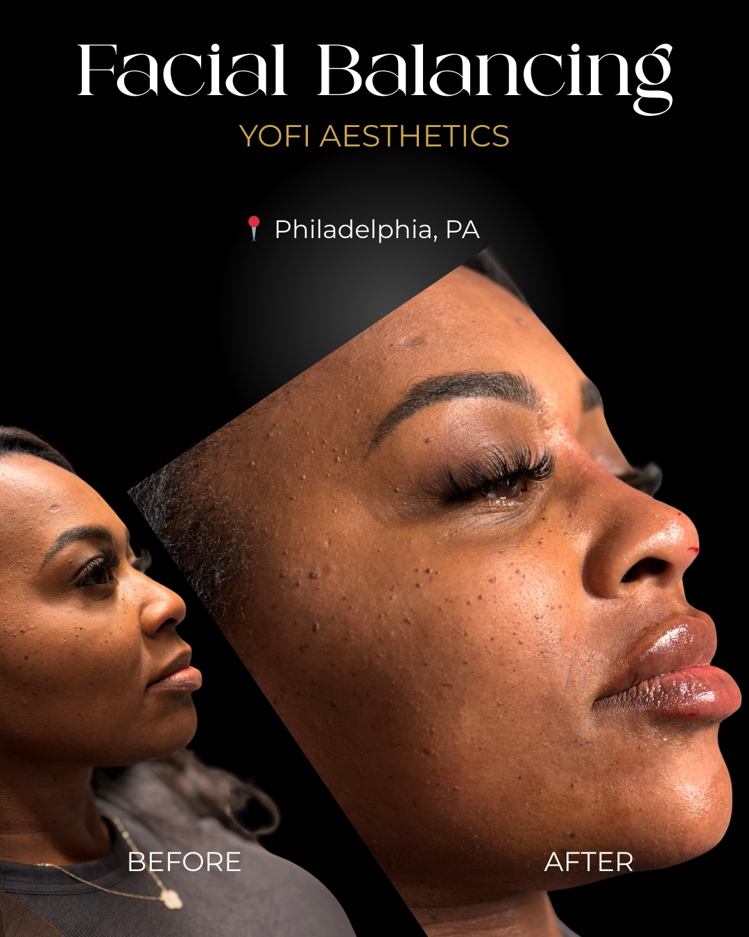 Before and after photos of a facial balancing procedure, Philadelphia. Woman with enhanced facial features.