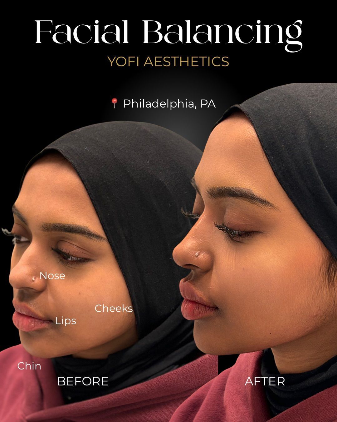 Before-and-after facial balancing promotion. A woman wearing a black hijab has altered nose, lips, cheeks, and chin.
