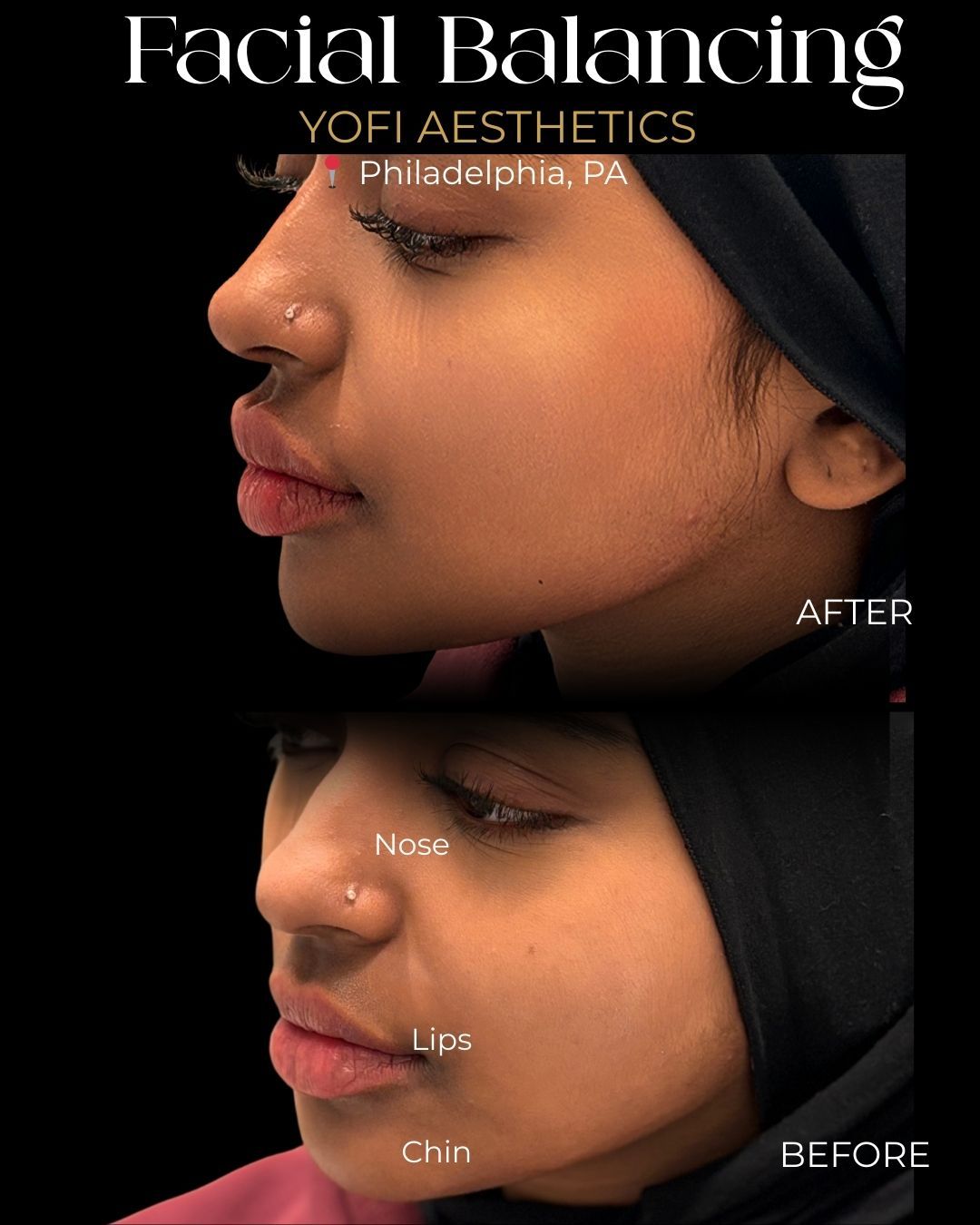 Before and after facial balancing comparison. Profile view of a person with the nose, lips, and chin labeled.