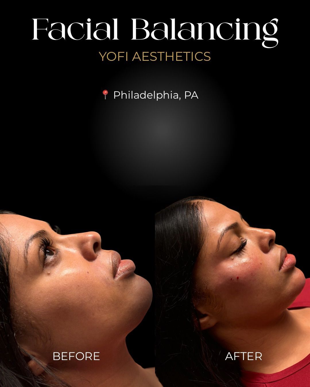 Facial balancing before/after. Woman with profile view, looking up. One side 