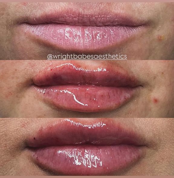 Progression of lip filler: Before, swollen, and final glossy result.