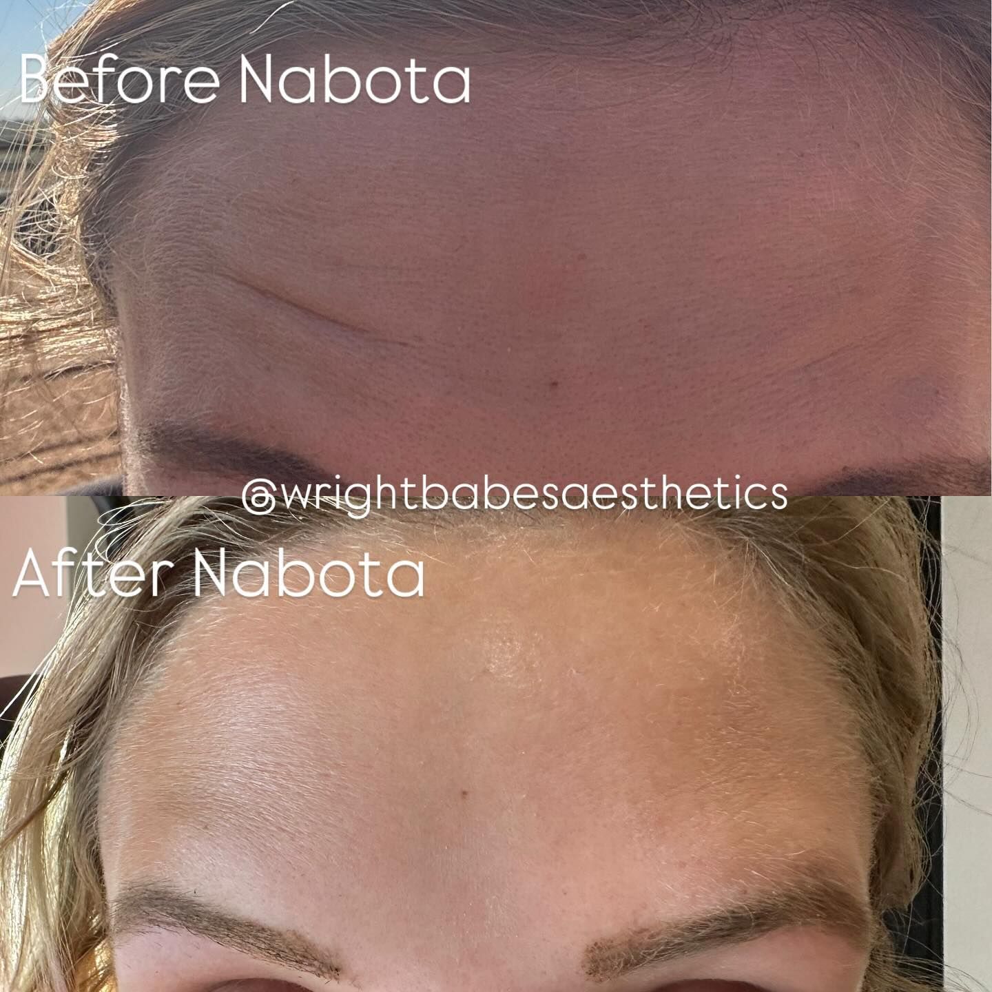 Forehead before and after Nabota injection. Wrinkles reduced, skin smoother.