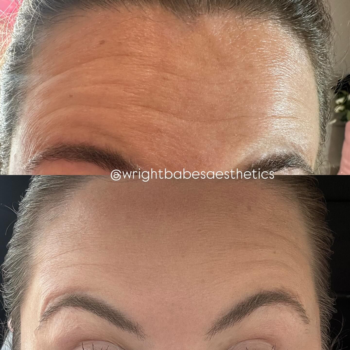 Forehead before and after treatment, showing fewer wrinkles and smoother skin.