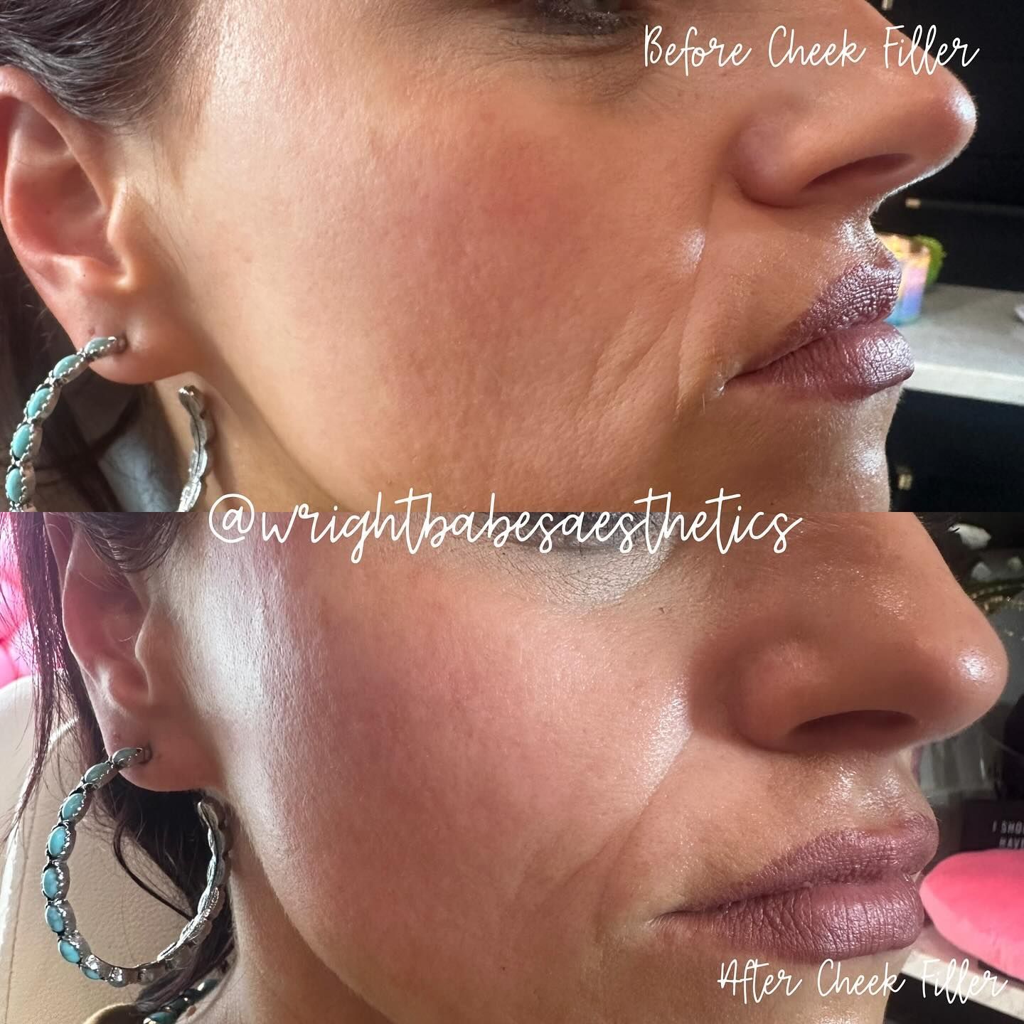 Side-by-side comparison of a person's face. Top: before cheek filler, showing wrinkles. Bottom: after, with smoother skin.
