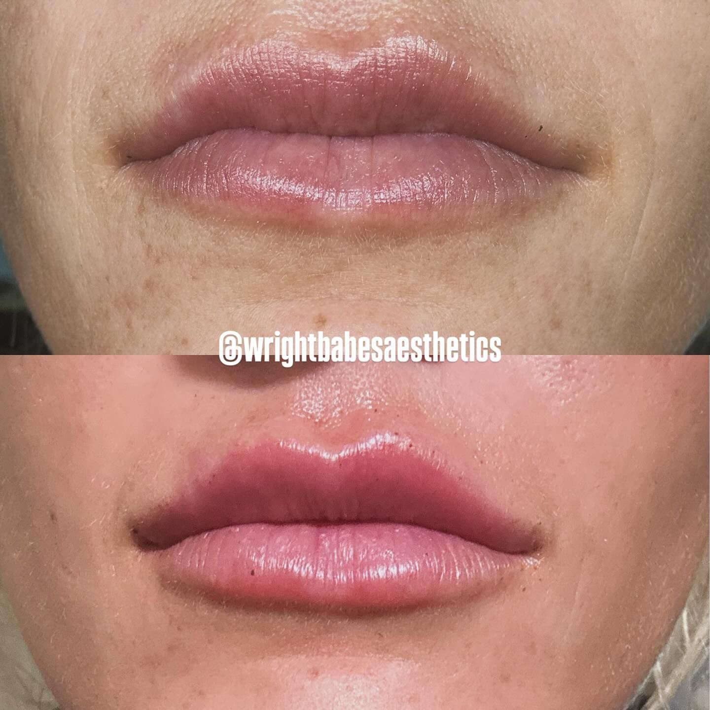 Before-and-after of lips; top shows thinner lips, bottom shows fuller lips post-filler.