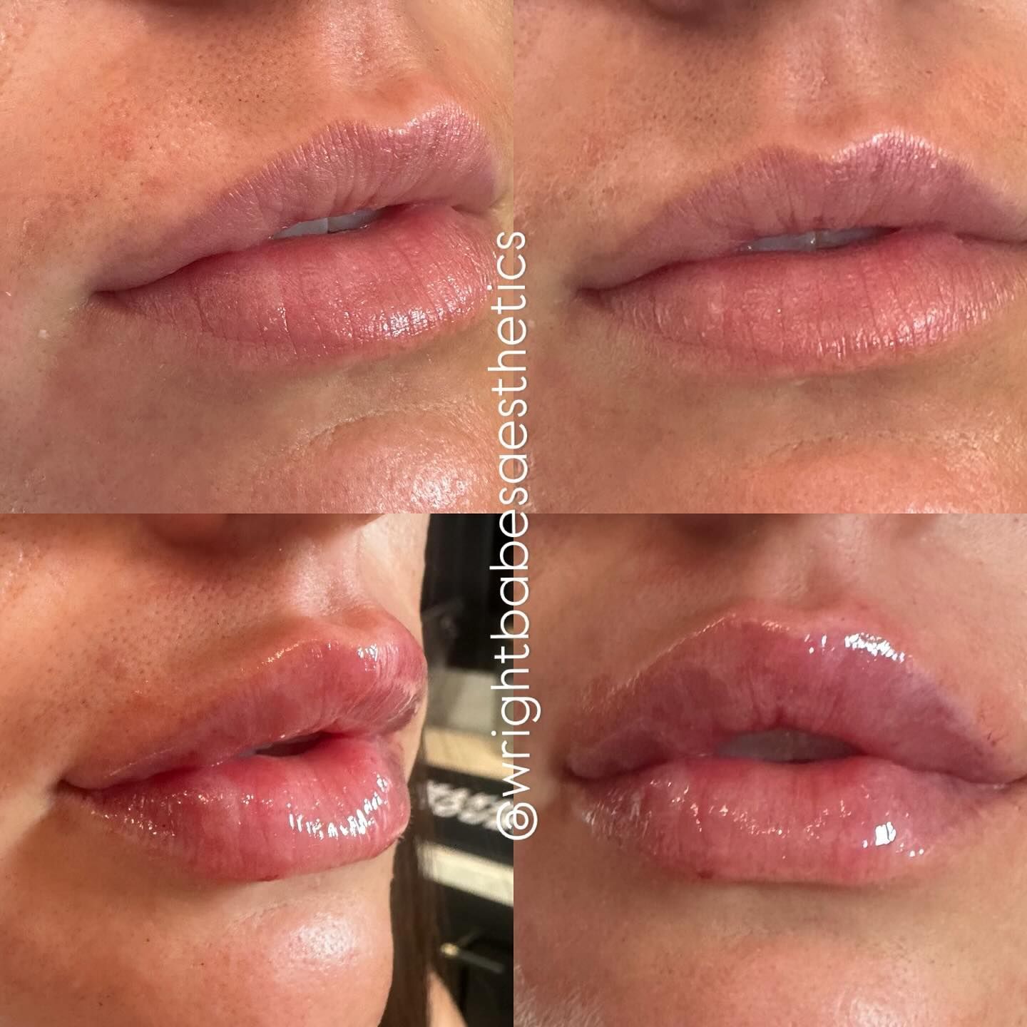 Four-part lip before and after comparison: natural lips, then enhanced with lip filler. Glossy finish.