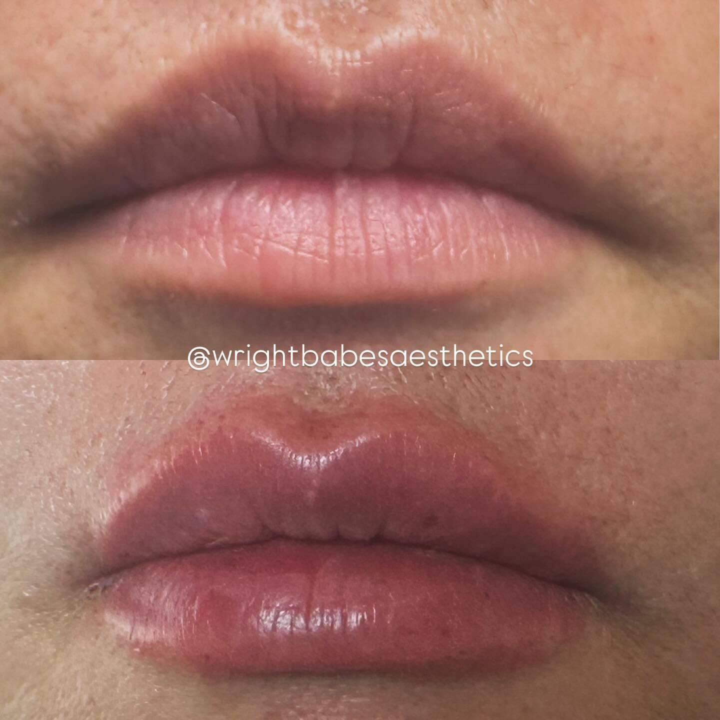 Before-and-after of lip fillers. Top: thinner lips, light skin. Bottom: fuller lips, flushed pink color.