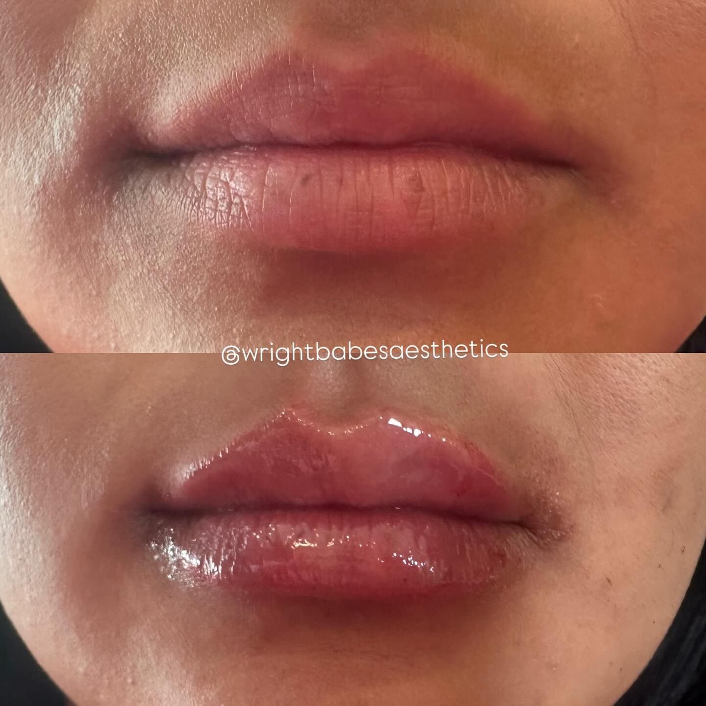 Before and after lip filler treatment: lips appear thinner then fuller, shiny with gloss.