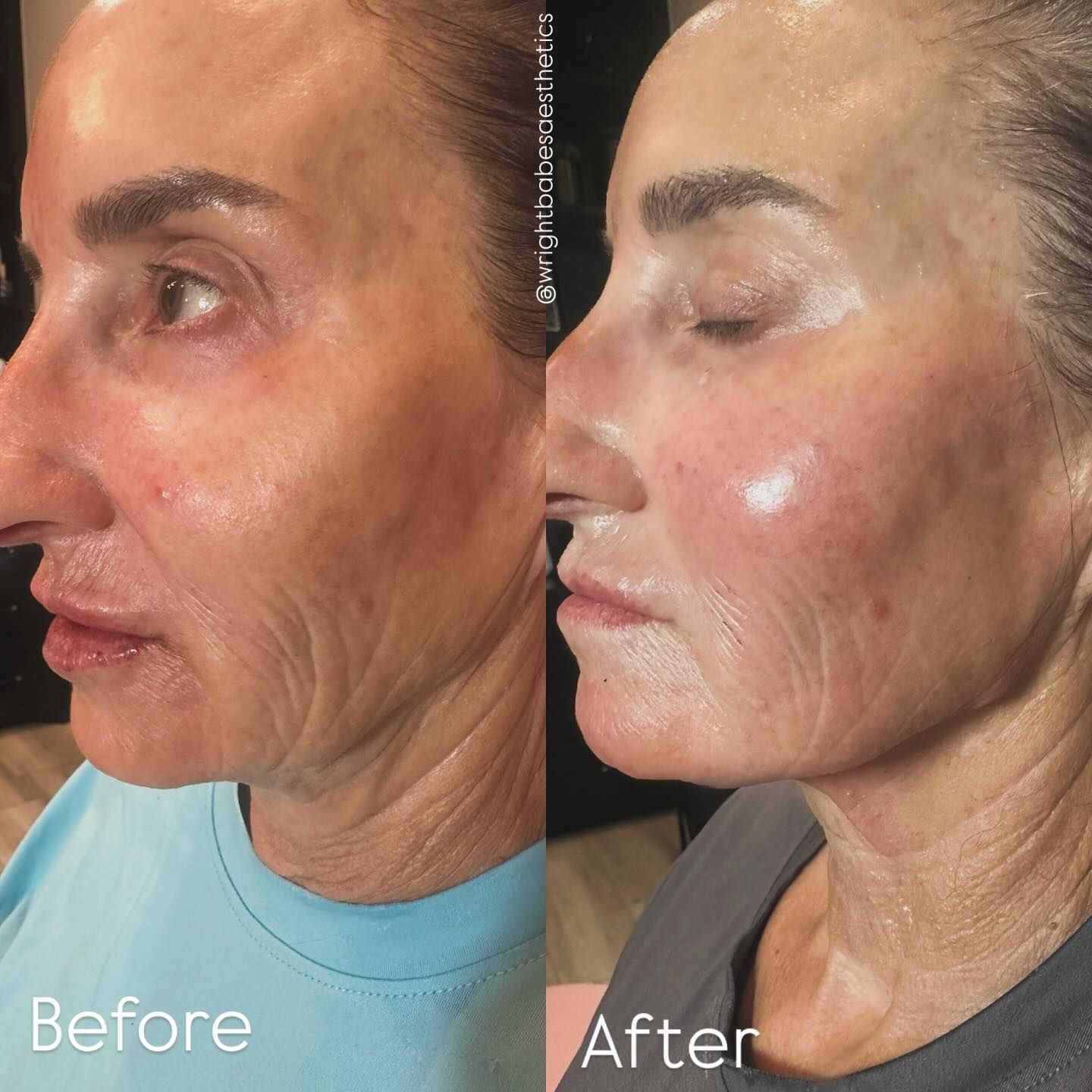 Side-by-side comparison of a person's face. Left side: before. Right side: after. Skin appears smoother, with less wrinkles.