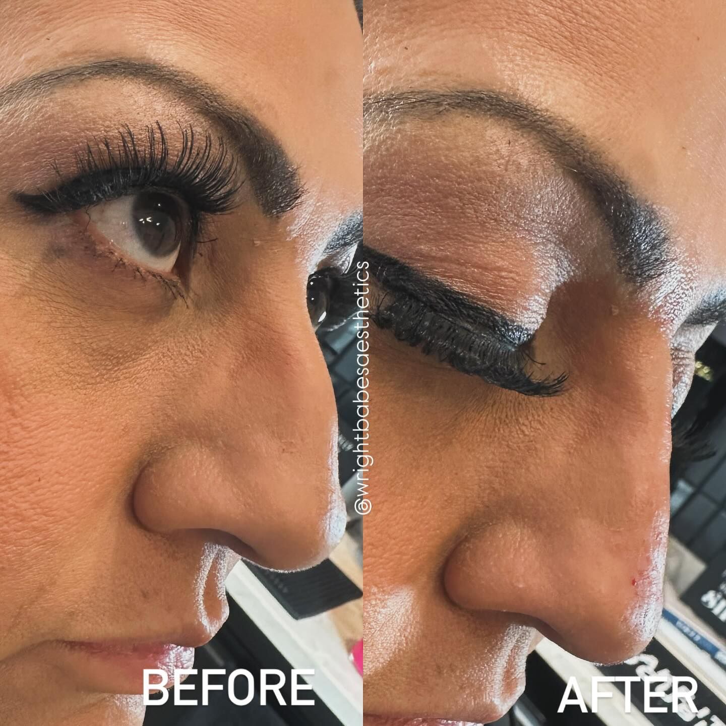 Comparison of a person's profile before and after a procedure; showing changes to the nose and under-eye area.