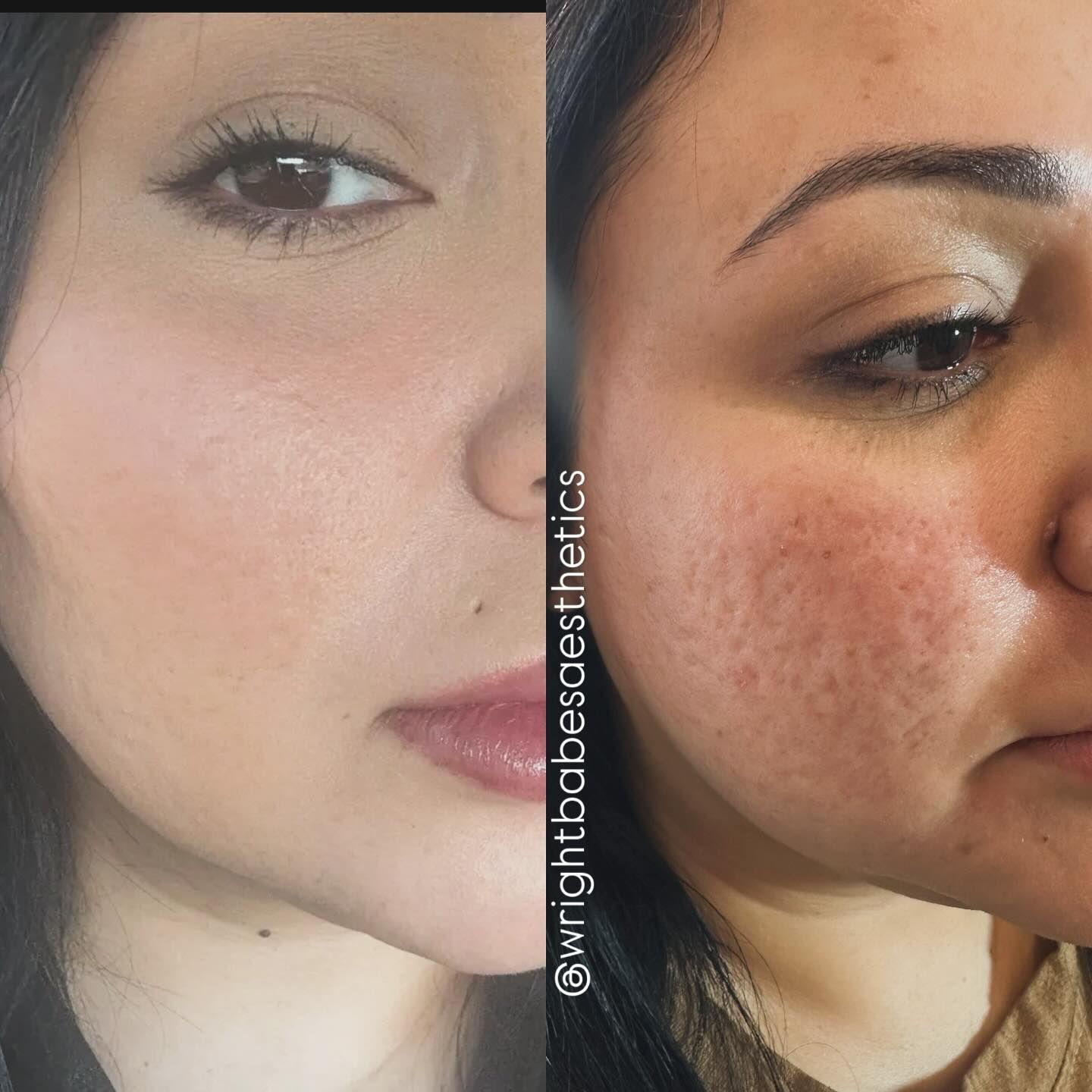 Comparison of a person's face before and after skin treatment, with a focus on skin texture.