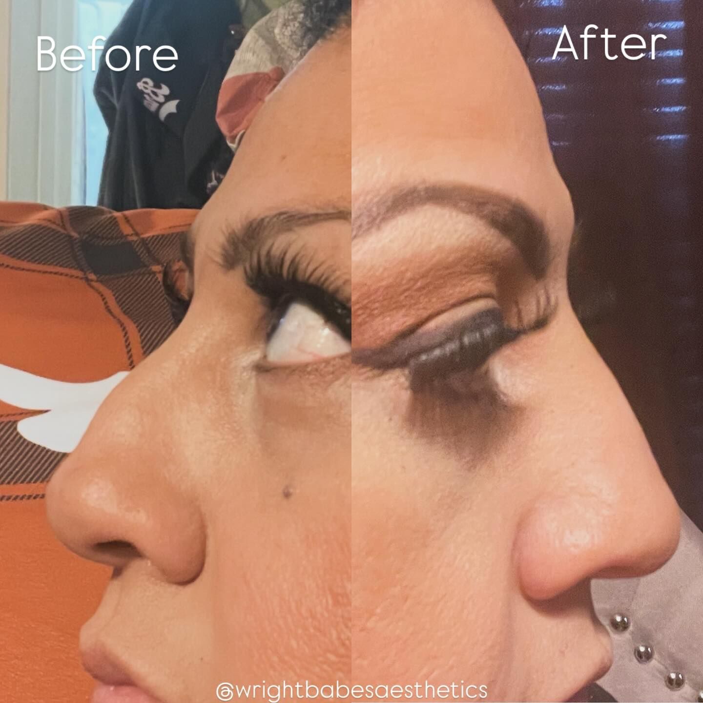 Side-by-side comparison of a person's nose before and after cosmetic alteration, showing a refined bridge.