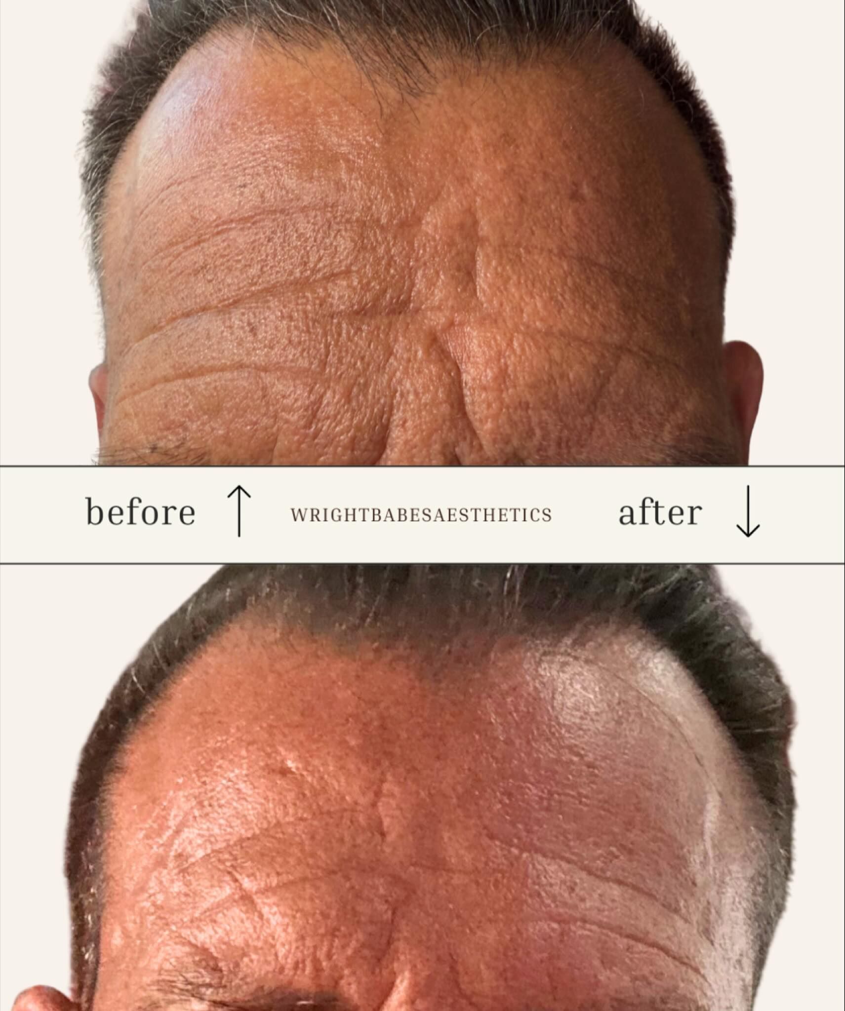 Forehead wrinkles before and after treatment. Smooth appearance achieved in after photo.