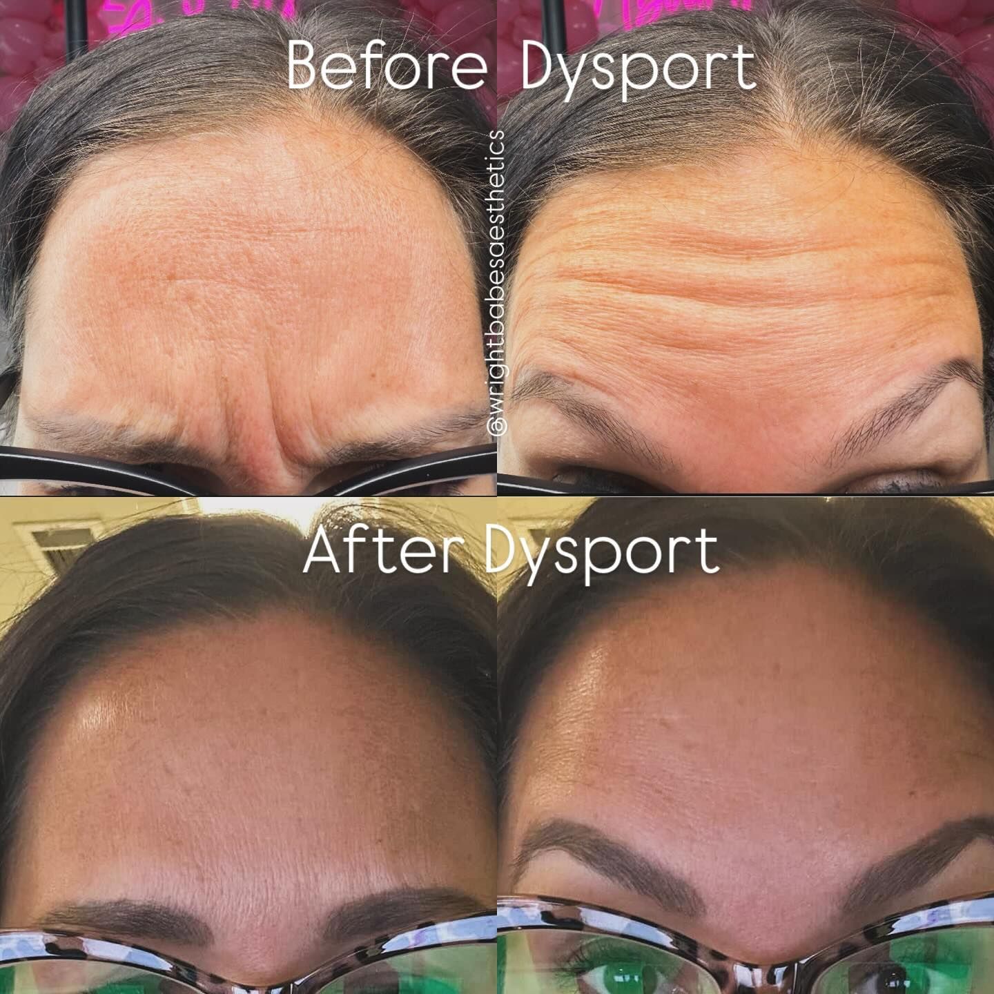 Before and after comparison of forehead wrinkles, top two photos show wrinkles, bottom two photos show smoother skin.