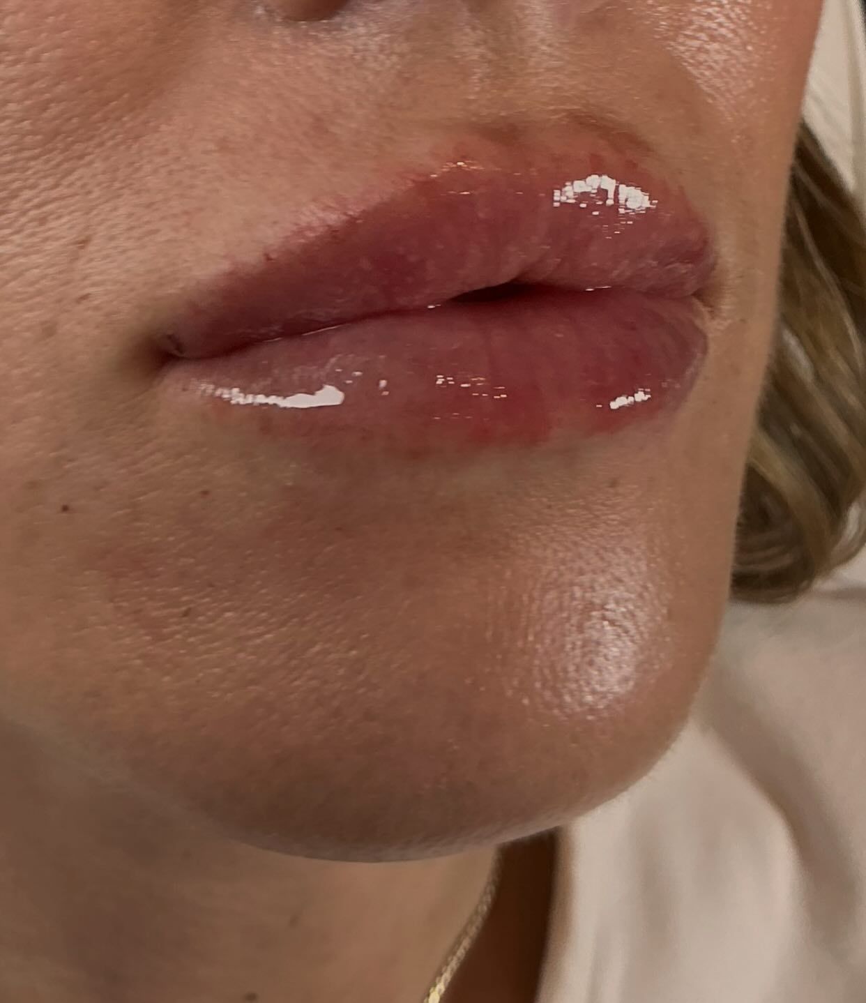 Close-up of a person's glossy, plump lips, likely with lip filler.