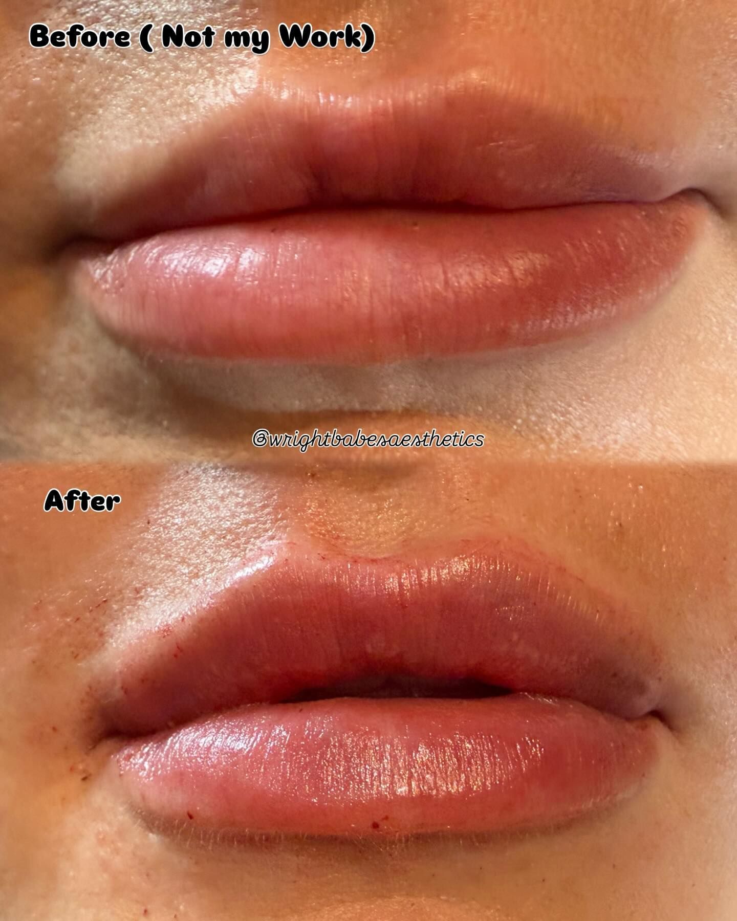 Before and after comparison of lip appearance. Upper lip shows thinner lips, lower image shows fuller lips with enhanced color.