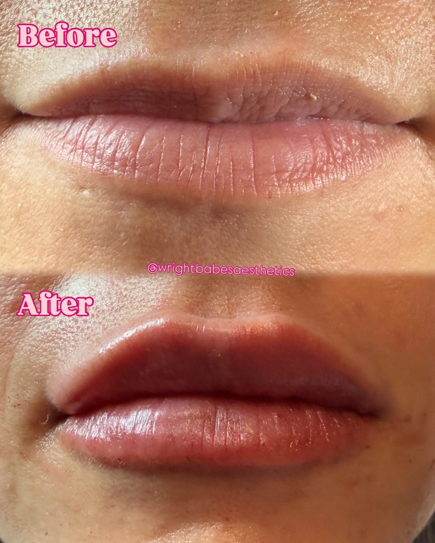 Comparison of lip appearance before and after a procedure, showing fuller lips after.