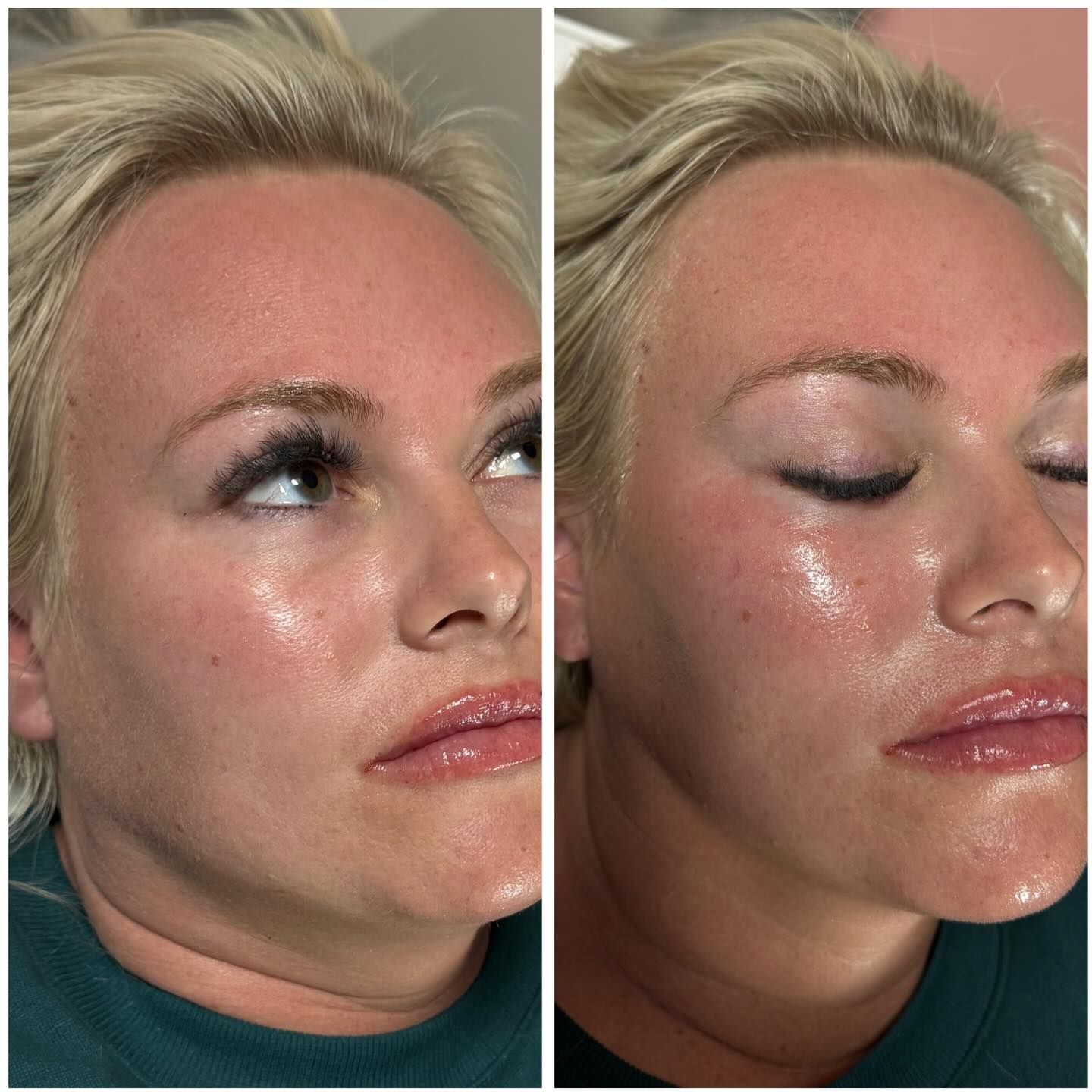 Two photos of a person's face; one with eyes open, other closed. Skin appears red and glossy.