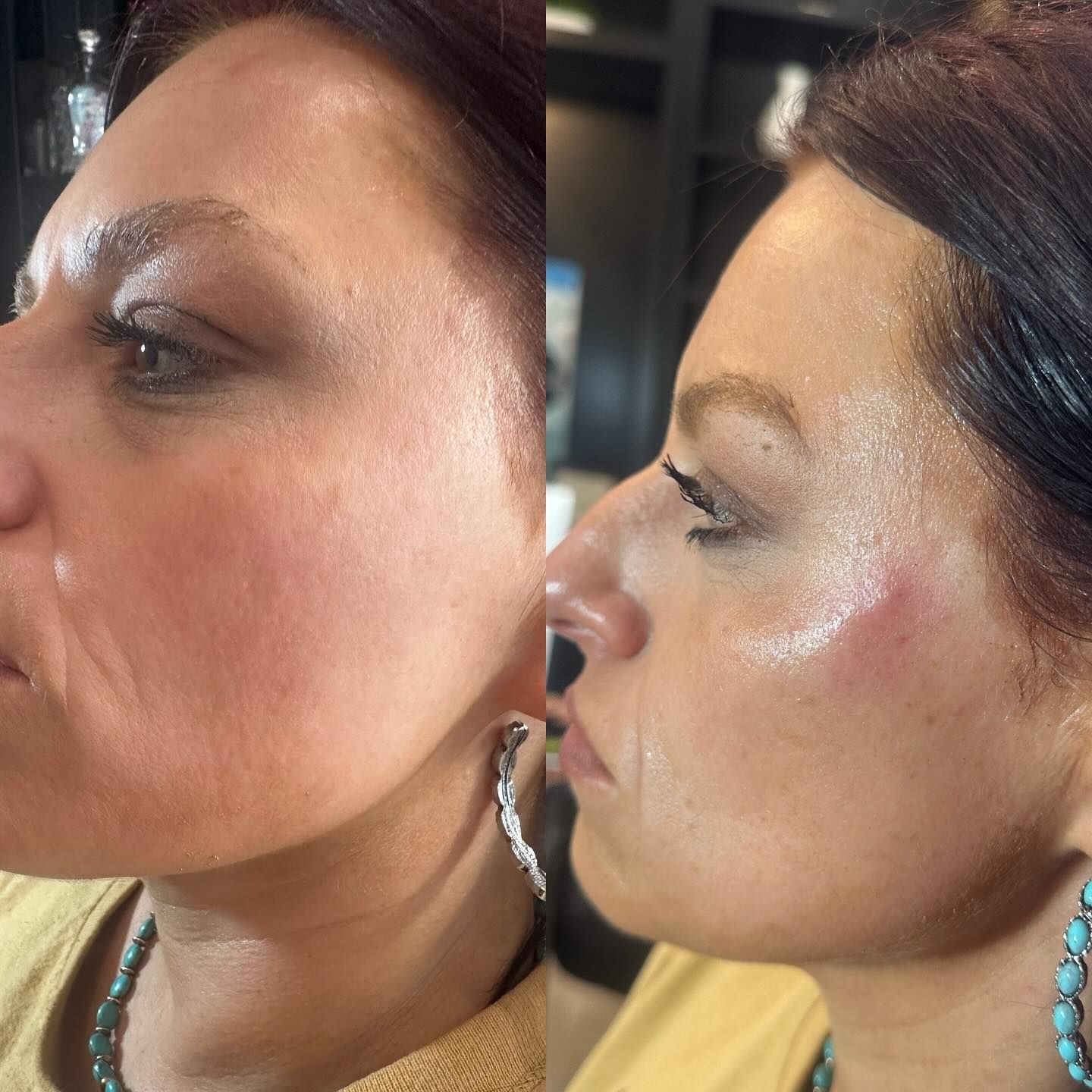 Side-by-side photos of a person's face. The right photo shows plumper cheek area than the left photo.