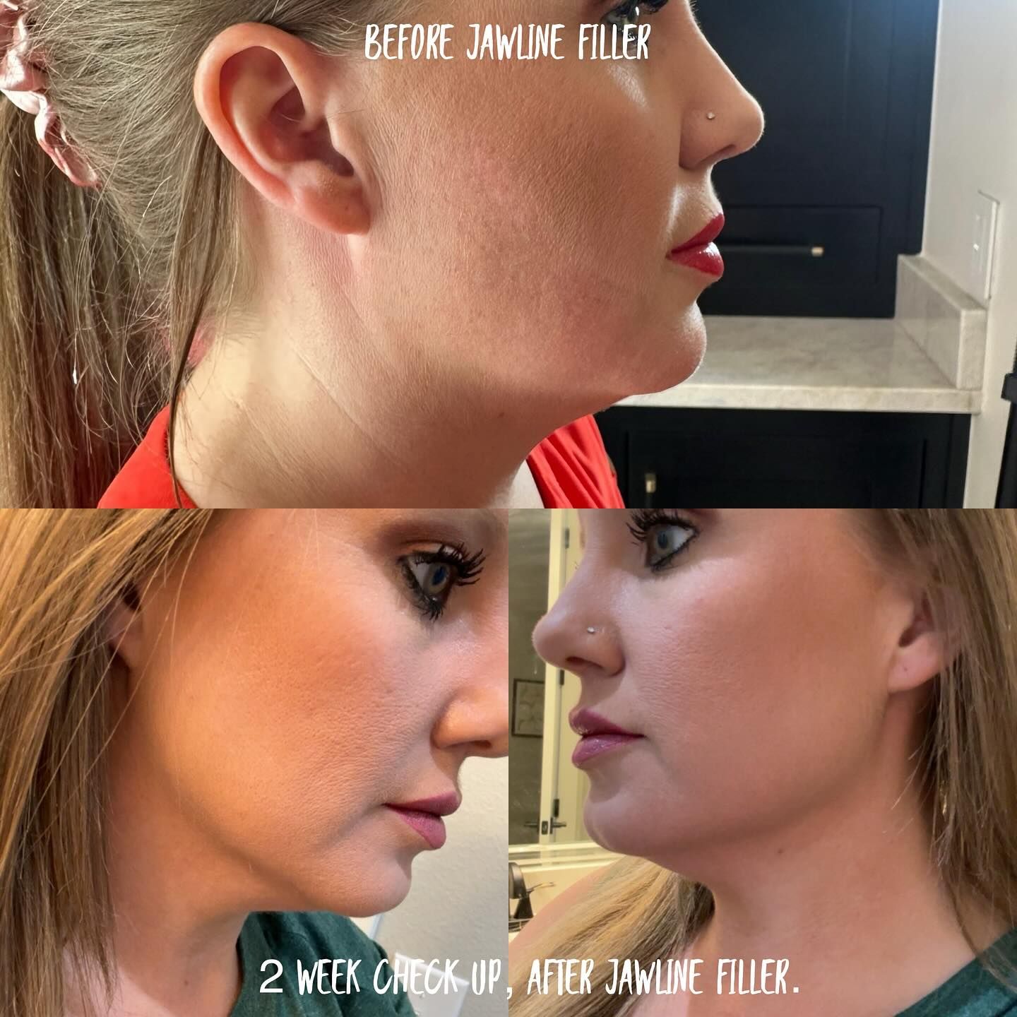 Side-by-side comparison of a person's profile before and after jawline filler treatment. The after image shows a more defined jawline.