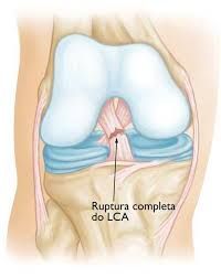 Blog-Lesão-do Ligamento-Cruzado-Anterior-16
