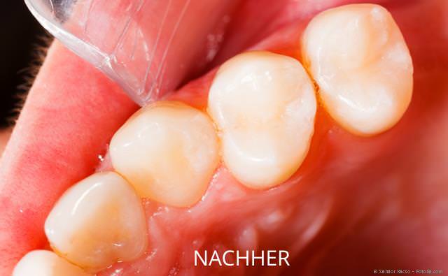 Hochwertige Zahnfüllungen - Zahnarzt Ehingen, Dr. C. Guter, G. Stiehle