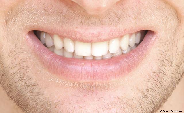 Derselbe Zahn wie oben mit einer unsichtbaren Komposit-Füllung Derselbe Zahn wie oben mit einer unsichtbaren Komposit-Füllung
