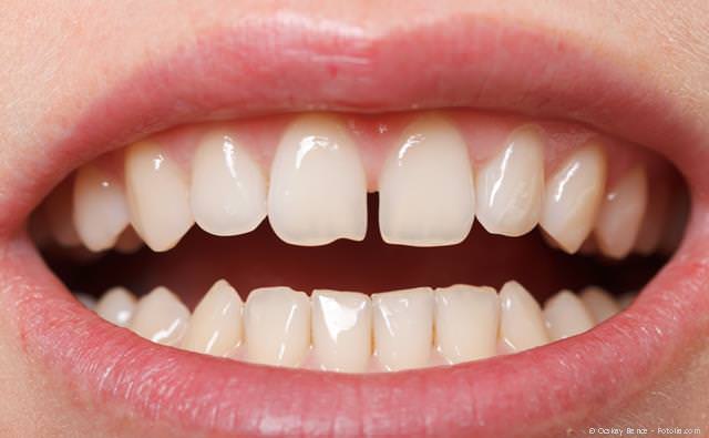 Sog. Diastema: Angeborene Lücke zwischen den oberen mittleren Schneidezähnen Sog. Diastema: Angeborene Lücke zwischen den oberen mittleren Schneidezähnen