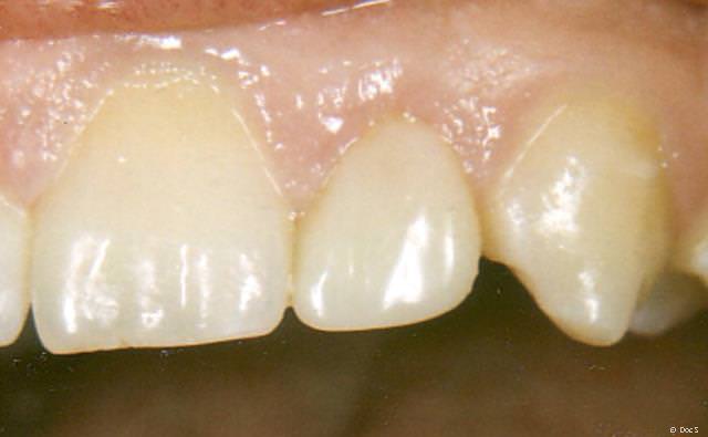 Optische Korrektur mit einem Veneer Optische Korrektur mit einem Veneer