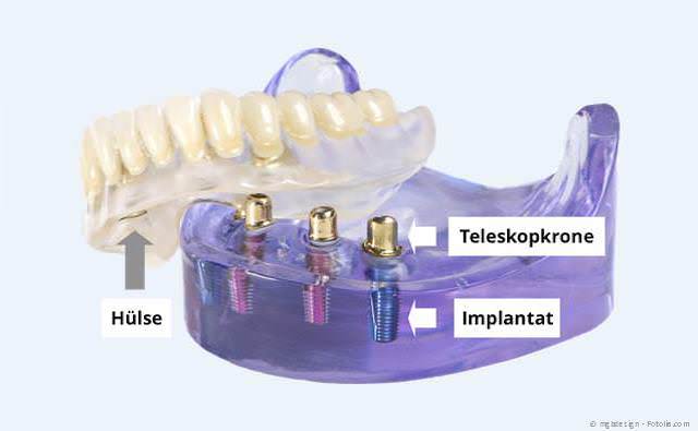 Mit nur wenigen Implantaten können Totalprothesen wieder einen sicheren Halt bekommen. Mit nur wenigen Implantaten können Totalprothesen wieder einen sicheren Halt bekommen.