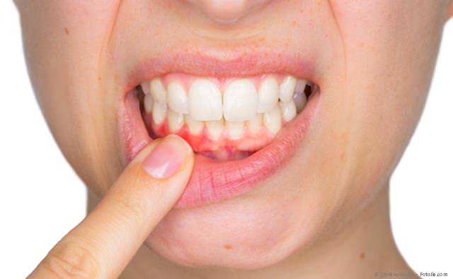 Laser gegen Lippen-Herpes und Aphthen Laser gegen Lippen-Herpes und Aphthen