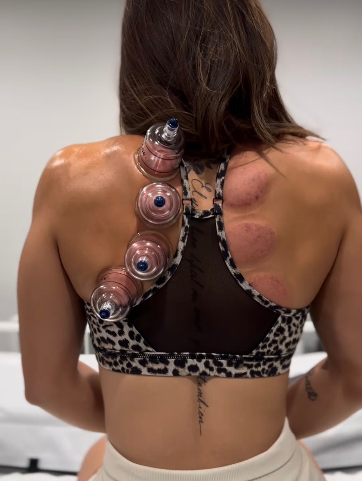 Cupping Therapy at Revive and Restore wellness and fitness Recover in Anaheim CA - Call (714) 844-2242