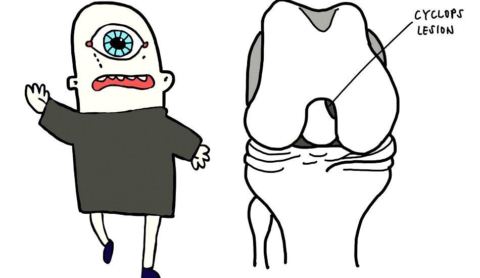 De cyclops-laesi uitgelegd aan de hand van twee foto's 