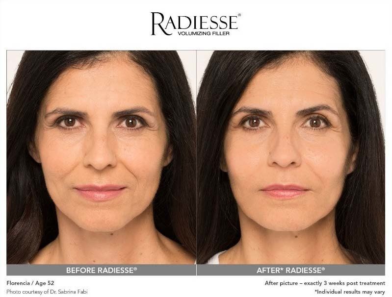 before_and_after_of_woman_using_radiesse