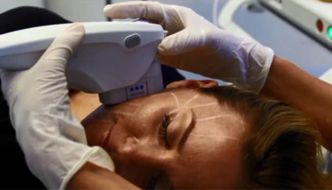 woman_being_treated_with_ultherapy