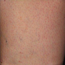 image_of_spider_veins_after_treatment